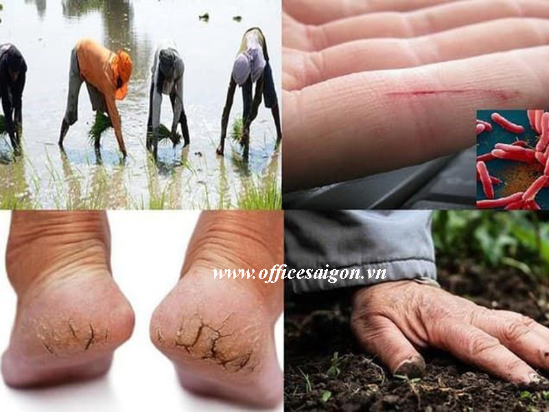 Những điều nên biết về vi khuẩn ăn thịt người